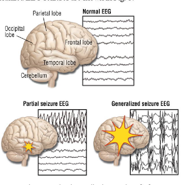 Study Of Normal And Abnormal Eeg | Semantic Scholar