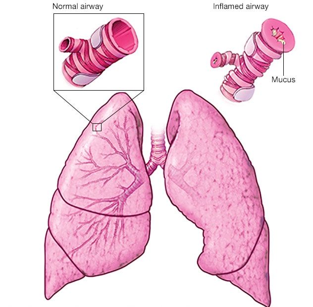 Asthma - Symptoms And Causes - Mayo Clinic