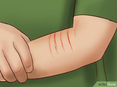 5 Ways To Deal With A Cat Scratch - Wikihow